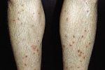 das Foto zeigt von Zerkarien-Dermatitis betroffene Unterschenkel