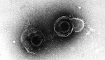 Varicella-zoster virus